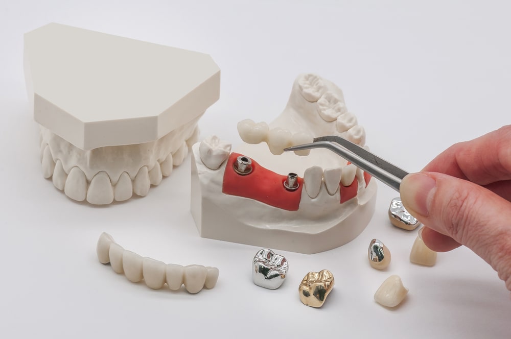 Dental Implants with Pro Grace Dentistry in Calgary