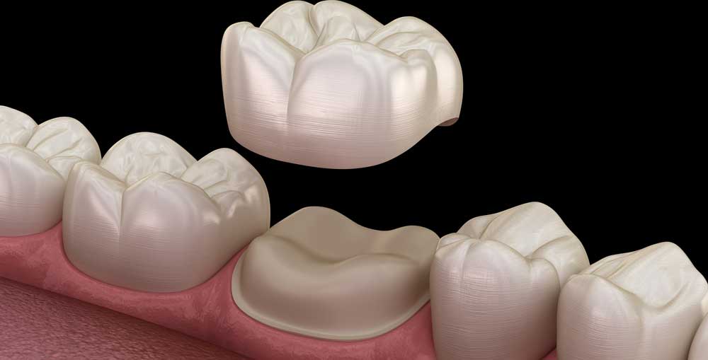 Crowns And Bridges: Dental Services In Calgary