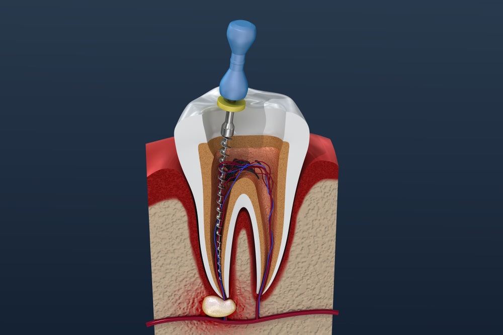 Root Canal Therapy Service in Calgary