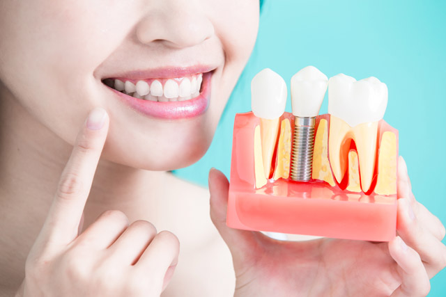 Woman holding model of dental implant